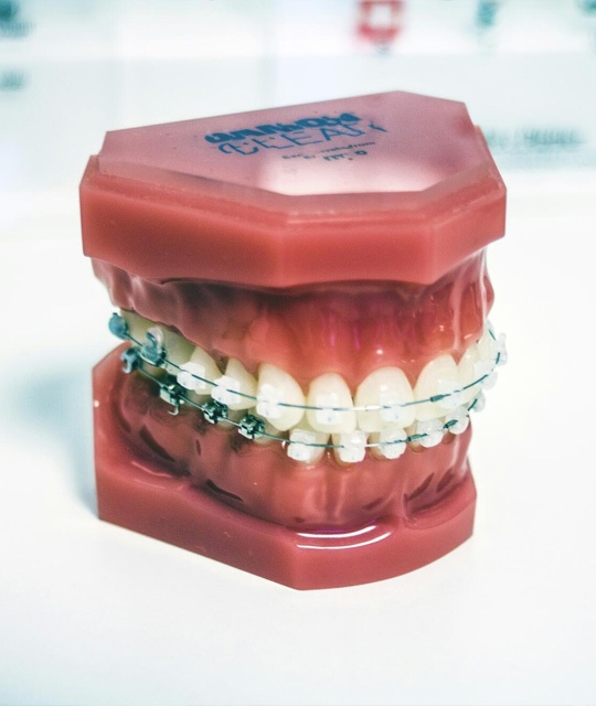 img-trmt-advbraces-01