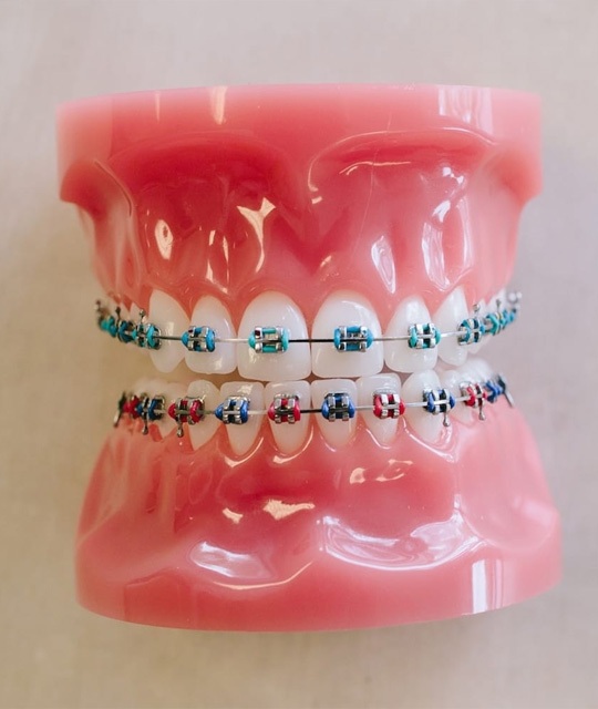 img-trmt-traditionalbraces-01