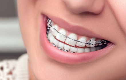 img-Advanced Technology Braces 
