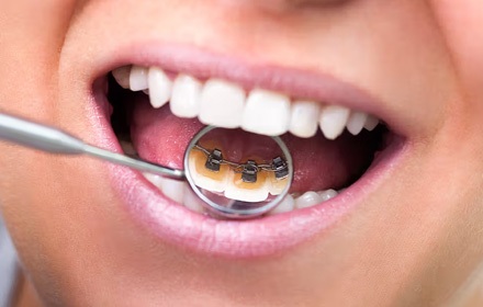 img-Lingual Braces 